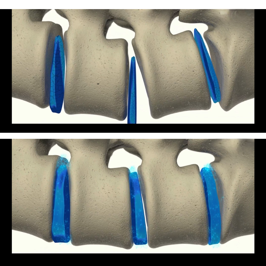 Spintrac Rücken- & Gelenktrainer - ganzheitl. Therapiesystem