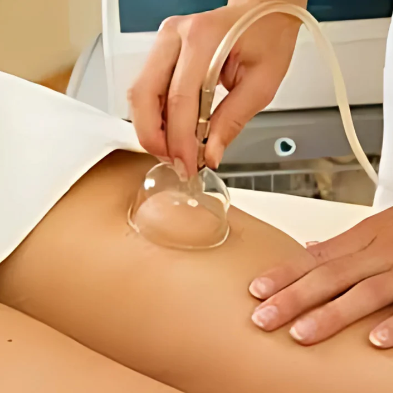 Schröpfmassage, Saugapplikatoren werden am Arm einer Frau angelegt